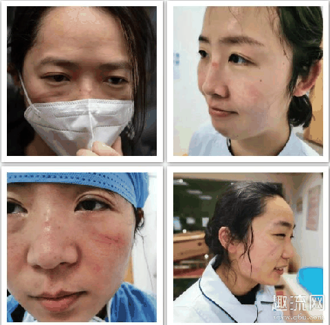 戴口罩脸上痒怎么办 为什么戴口罩脸部容易过敏