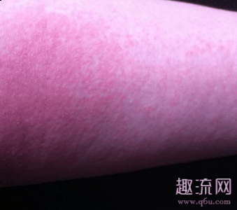 甚至引起肾功潮牌能衰竭和休克（出血热是什么病 汉坦病毒引起什么疾病）