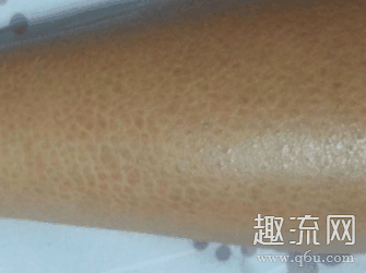 小腿有鱼鳞纹怎么去除 小腿有鱼鳞纹可以纹身吗